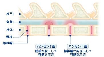 ハンセン1型