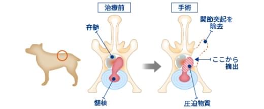 片側椎弓切除術