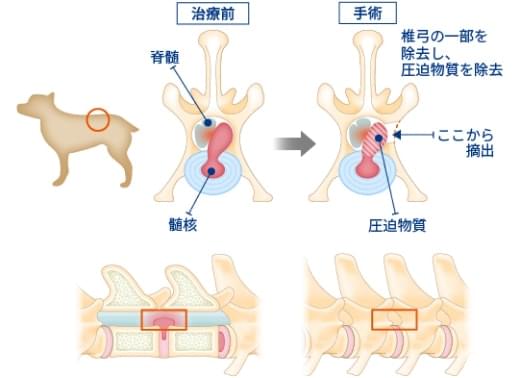 部分的側方椎体切除術