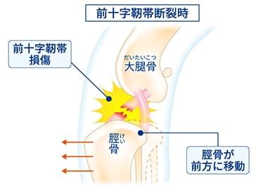 前十字靭帯断裂