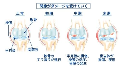 前十字靭帯断裂の症状