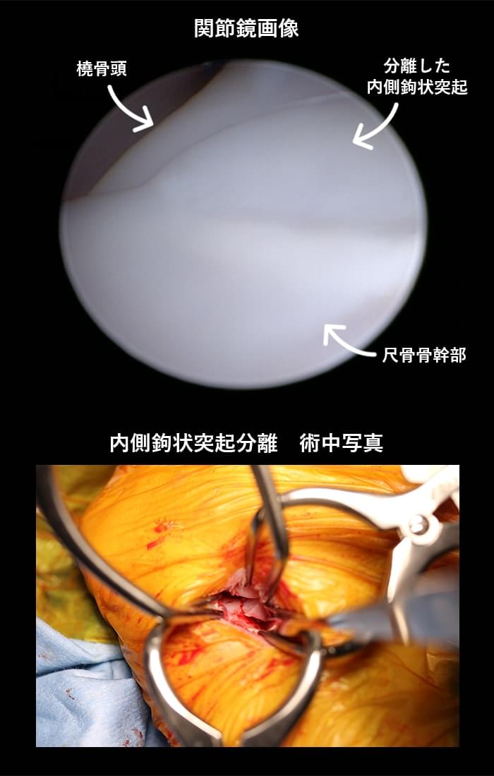 内側鉤状突起分離の治療法