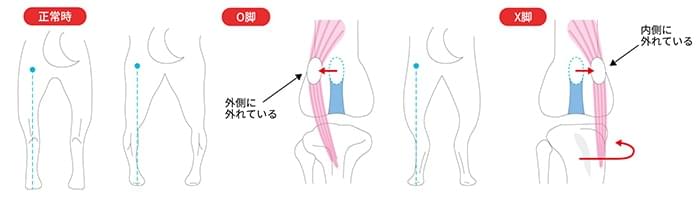 膝蓋骨脱臼の症状