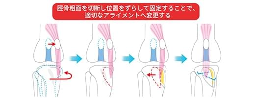 脛骨粗面転位術