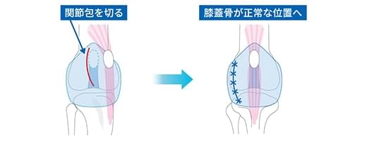 外側（膝蓋骨外方脱臼では内側）組織の縫縮