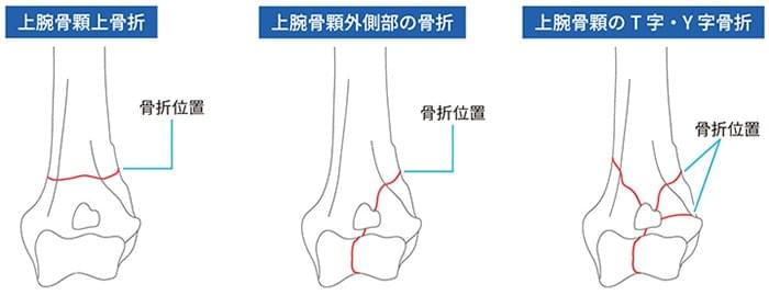 上腕骨骨折の治療