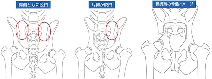 骨盤骨折の治療