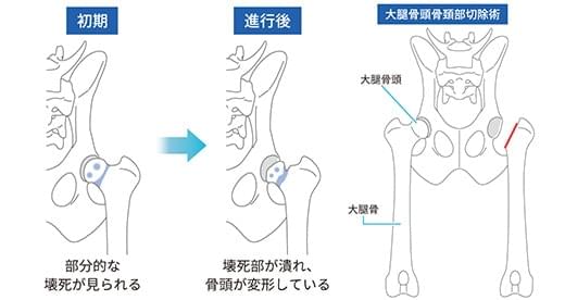 股関節脱臼の治療