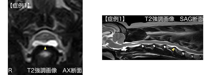 水和髄核逸脱症(HNPE)の診断