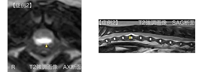 水和髄核逸脱症(HNPE)の診断