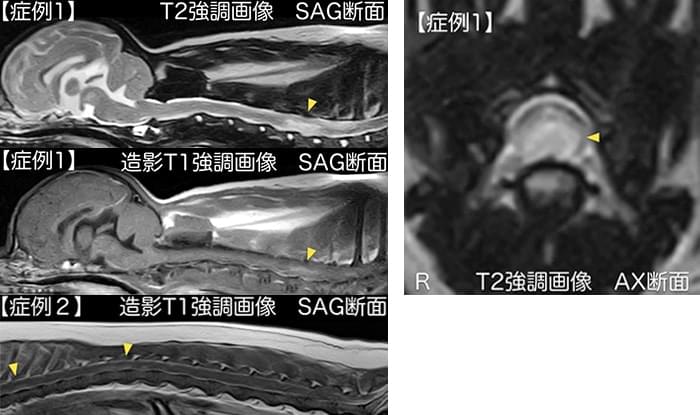 特発性脊髄炎(非感染性脊髄炎)の診断