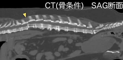 椎体骨折・椎体脱臼の診断 CT