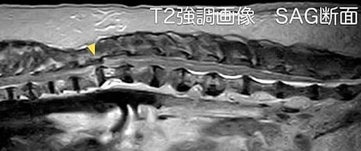 椎体骨折・椎体脱臼の診断 MRI