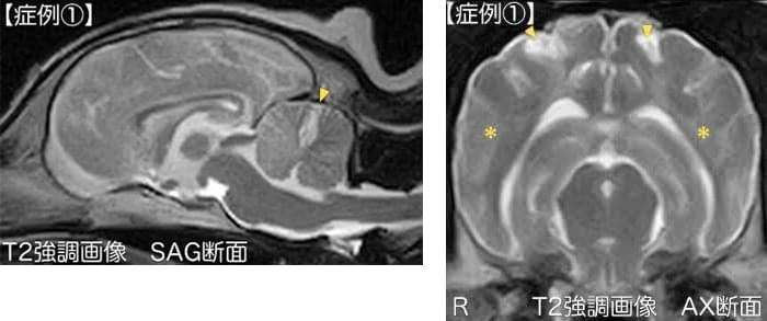 特発性脳炎(特発性非感染性脳炎)の診断